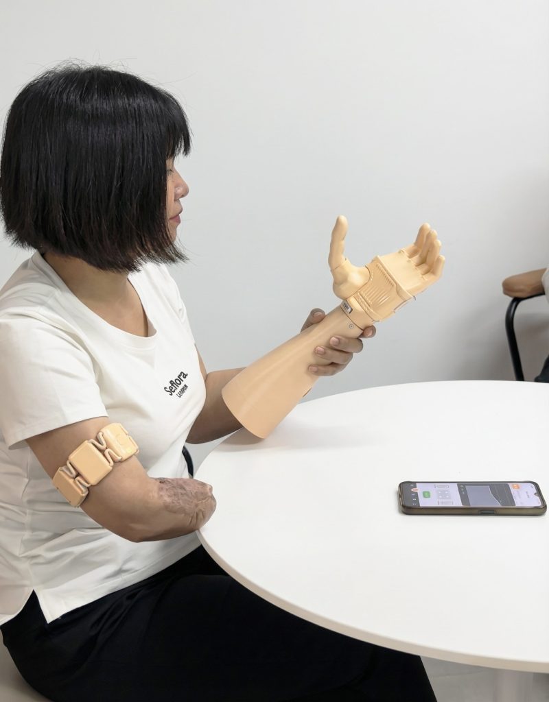 A detailed view of a patient with a transradial (below-elbow) residual limb, wearing the Vulcan Myoband EMG sensor band on her upper arm. A smartphone displays the 'Signal History' graph in the Vulcan companion app.