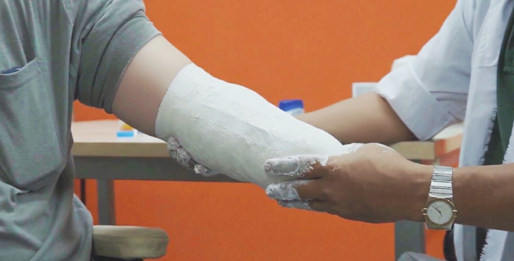 A prosthetist is applying plaster bandage to create a cast of a transradial residual limb for Vulcan socket fabrication. 