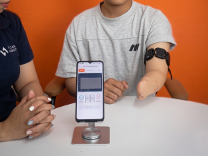 A clinician and a patient with a transradial amputation evaluating real-time EMG signals. The patient wears a Vulcan wireless myoband on the residual limb, while a smartphone on a stand displays a visual graph of muscle activation thresholds.