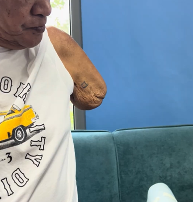 A close-up side profile of an elderly individual with an upper-limb amputation above the elbow. The residual limb shows visible skin wrinkling and signs of muscle atrophy. A small, simple square tattoo is visible on the side of the limb.